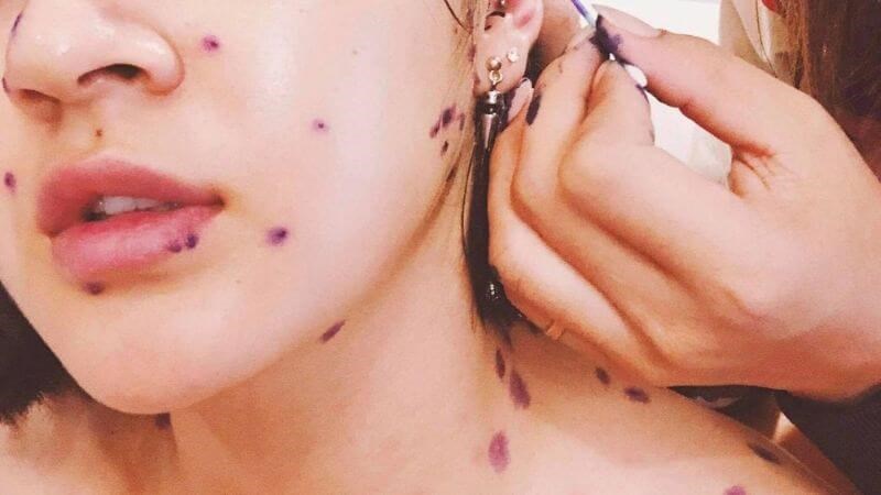 Thuốc bôi ngoài da giúp điều trị thủy đậu