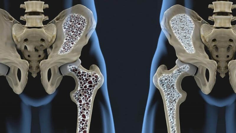 Bệnh Celiac có thể dẫn đến giảm mật độ xương