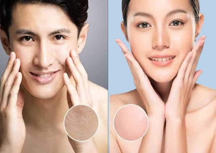 Lượng dầu tiết ra nhiều trong thời gian dài làm cho các lỗ chân lông ngày càng to ra ở nam giới