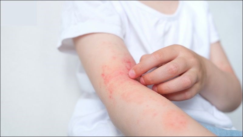 Không nên tiêm phòng cho trẻ nếu trẻ bị dị ứng với thành phần nào của vắc xin