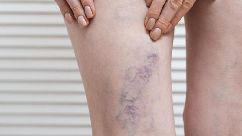 Ớt chuông ngăn ngừa giãn tĩnh mạch