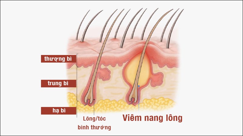 Viêm nang lông là bệnh lý nhiễm trùng các nang tóc, nang lông trên cơ thể