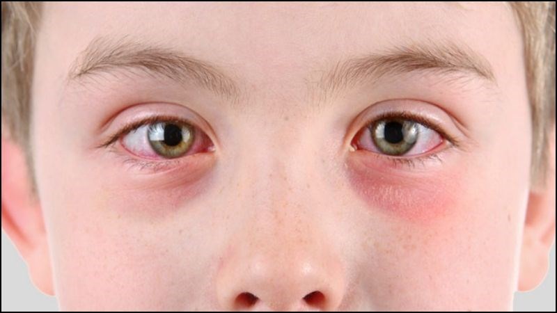 Ngứa kh&oacute;e mắt được chẩn đo&aacute;n dựa v&agrave;o việc ngứa mắt li&ecirc;n tục k&egrave;m sưng đỏ