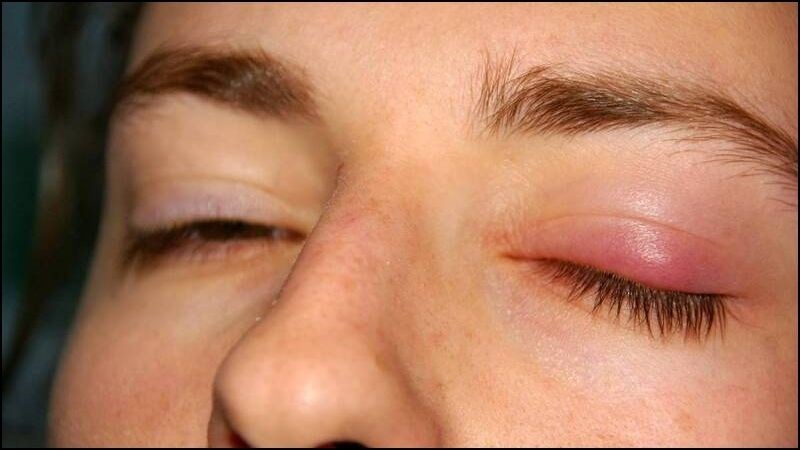 Vi&ecirc;m bờ mi l&agrave; một trong c&aacute;c nguy&ecirc;n nh&acirc;n phổ biến g&acirc;y ngứa kh&oacute;e mắt