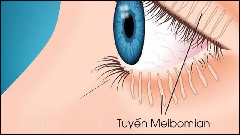 Rối loạn chức năng tuyến Meibomian g&acirc;y kh&ocirc; v&agrave; ngứa kh&oacute;e mắt