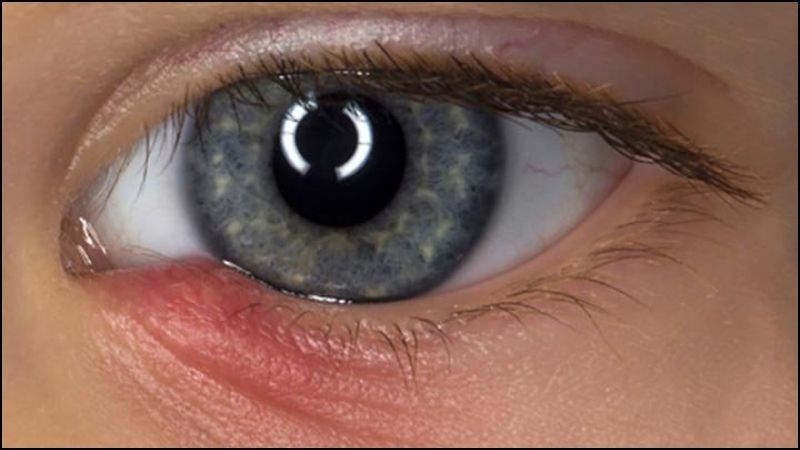 Vi&ecirc;m t&uacute;i lệ c&oacute; thể g&acirc;y tắc nghẽn lệ đạo, từ đ&oacute; g&acirc;y t&igrave;nh trạng ngứa kh&oacute;e mắt