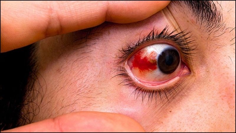 Xuất huyết dưới kết mạc g&acirc;y n&ecirc;n t&igrave;nh trạng ngứa kh&oacute;e mắt