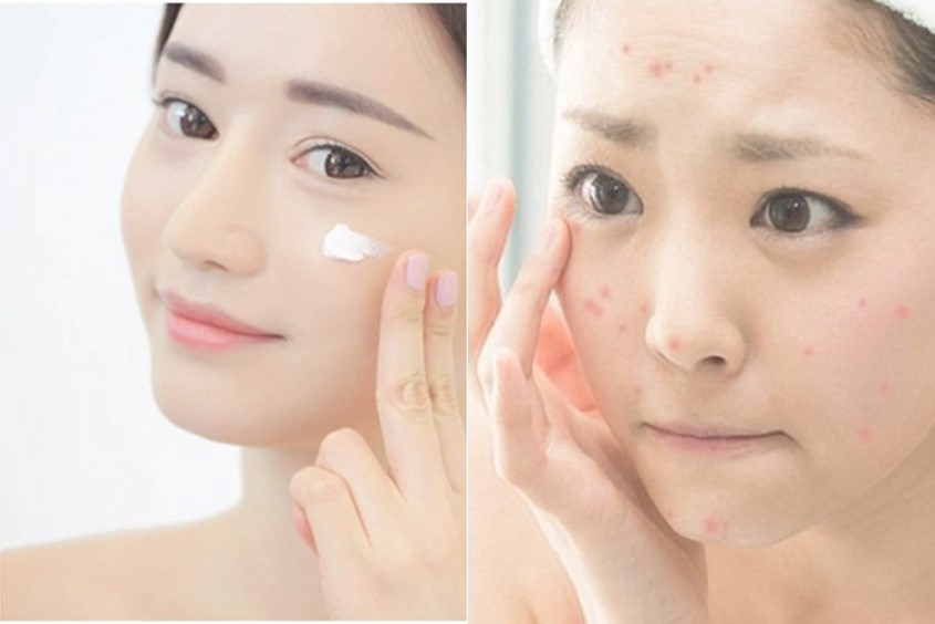 Những điều cần lưu ý khi áp dụng các cách chăm sóc da mặt bị mụn