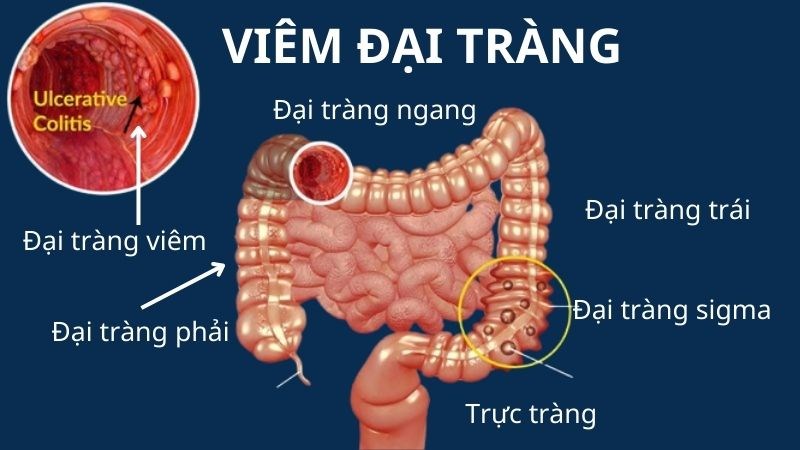 Viêm đại tràng là viêm vùng đại - trực tràng
