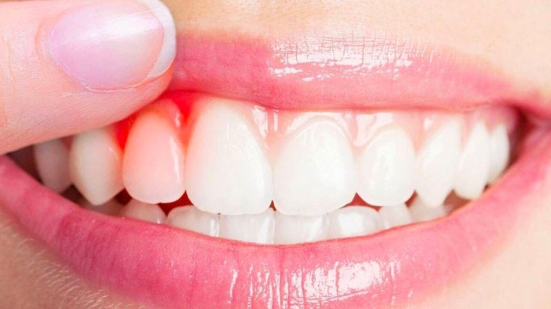Lợi khi bị kích ứng sẽ có hiện tượng viêm, đỏ