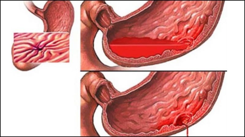 Biến chứng chảy máu ruột thường xuất hiện vào tuần thứ 3 sau khi phát bệnh Biến chứng chảy máu ruột thường xuất hiện vào tuần thứ 3 sau khi phát bệnh