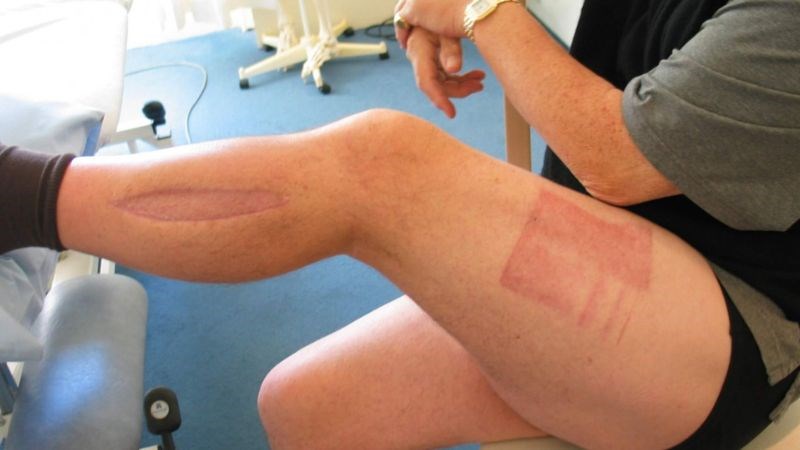 Chèn ép khoang là biến chứng của gãy chân cần được cấp cứu sớm Chèn ép khoang là biến chứng của gãy chân cần được cấp cứu sớm