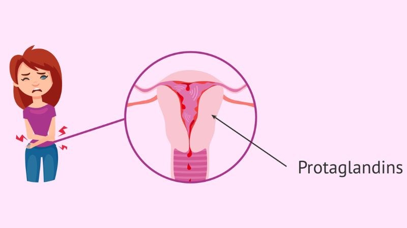 Prostaglandin kích thích các cơ tử cung co bóp nhiều hơn, làm tăng thêm mức độ đau Prostaglandin kích thích các cơ tử cung co bóp nhiều hơn, làm tăng thêm mức độ đau