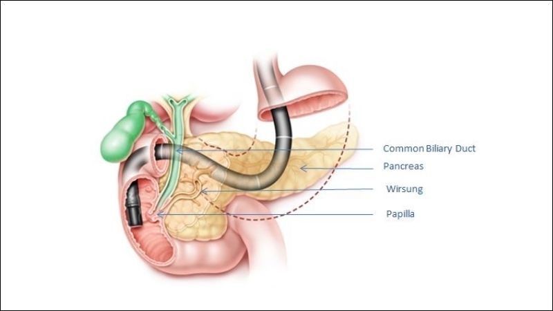 Chụp mật tụy ngược dòng qua nội soi là một phương pháp tầm soát ung thư gan