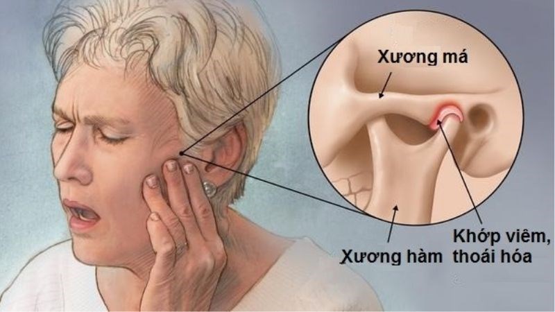 Viêm khớp thái dương hàm gây đau ở khớp và các cơ chuyển động của hàm