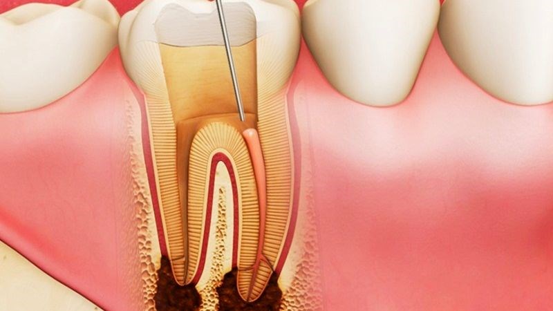 Viêm tủy răng có thể gây những cơn đau đớn, khó chịu vùng răng miệng 