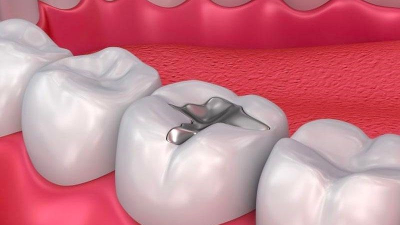 Khi trám răng, bạn có thể bị phản ứng dị ứng với vật liệu trám bạc