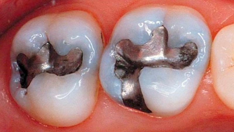 Miếng trám bạc có thể bị lỏng hoặc vỡ