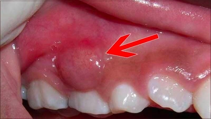 Sâu răng lâu ngày có thể dẫn tới tình trạng áp xe răng