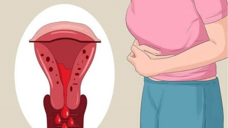 Một trong những nguyên nhân gây rong kinh bệnh lý là u xơ tử cung