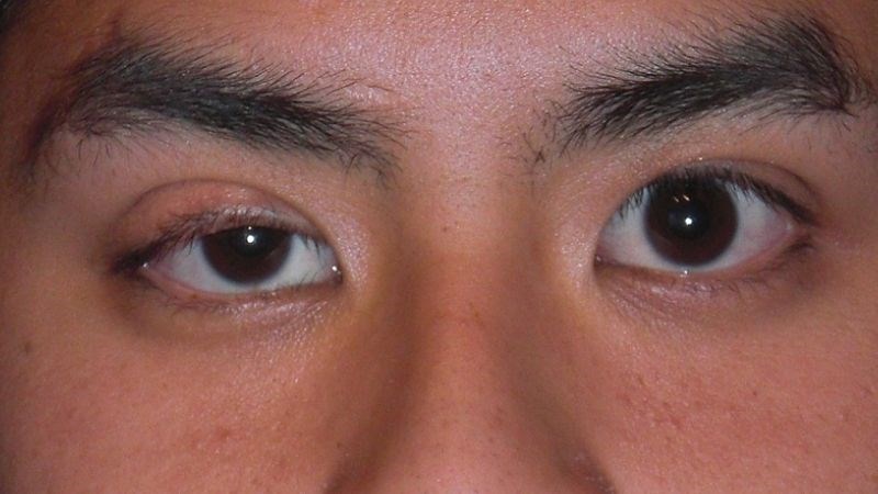 Mí mắt sụp xuống là tình trạng phổ biến ở người lớn tuổi