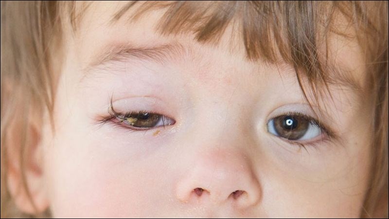 Một số em bé được sinh ra đã bị sụp mi bẩm sinh