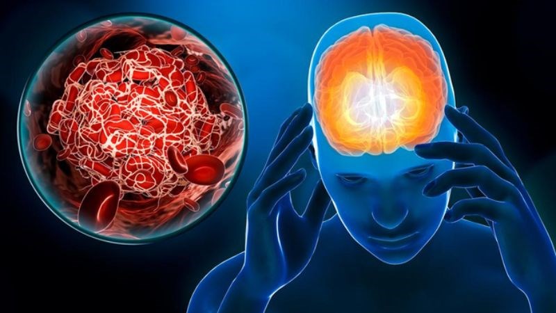 Sụp mí có thể là triệu chứng khi bị đột quỵ