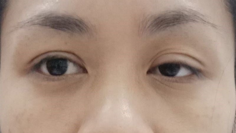 Các loại chấn thương có thể vô tình làm tổn thương gây sụp mí