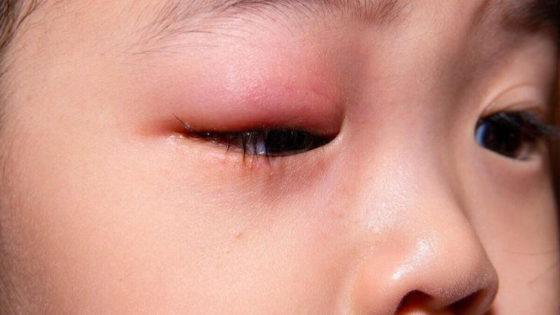 Bệnh nhiễm trùng có thể khiến mắt bạn sưng lên và sụp mí