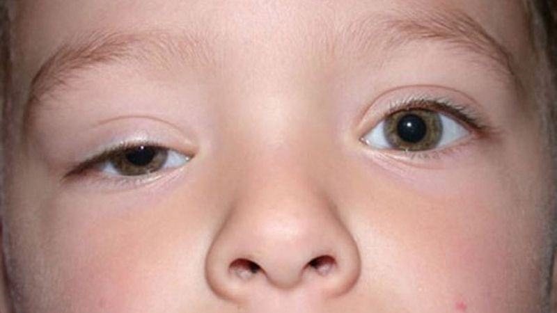 Sụp mí mắt có thể di truyền trong gia đình