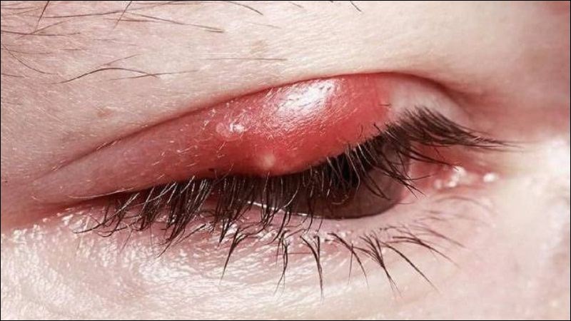 U mí mắt là một dạng sụp mí cơ học