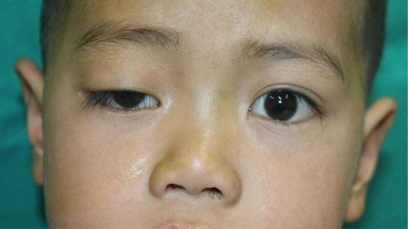 Mí mắt sụp xuống có thể là dấu hiệu của bệnh loạn dưỡng cơ mắt - hầu