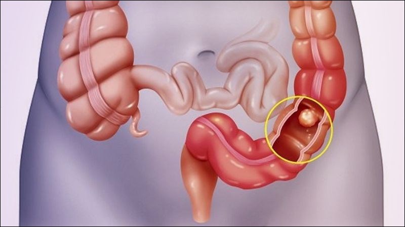 Bệnh Crohn nói chung - viêm loét đại tràng có thể dẫn đến thiếu máu mạn tính