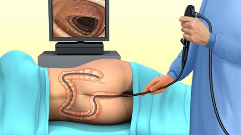 Nội soi đại tràng giúp quan sát các cấu trúc bên trong đại tràng