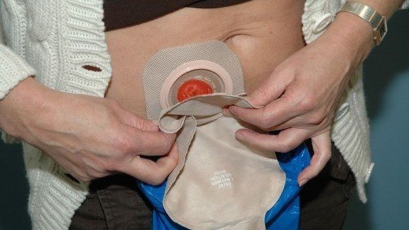 Hậu môn nhân tạo nối thông ruột ra bên ngoài