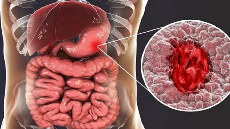 Loét dạ dày là tình trạng tế bào niêm mạc dạ dày bị viêm nhiễm lâu ngày