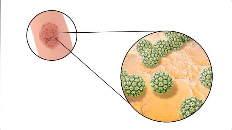 90% bệnh nhân mắc sùi mào gà là do HPV loại 6 và 11 gây ra