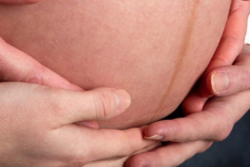 Mẹ bầu không thể ngăn ngừa vạch nâu trên bụng