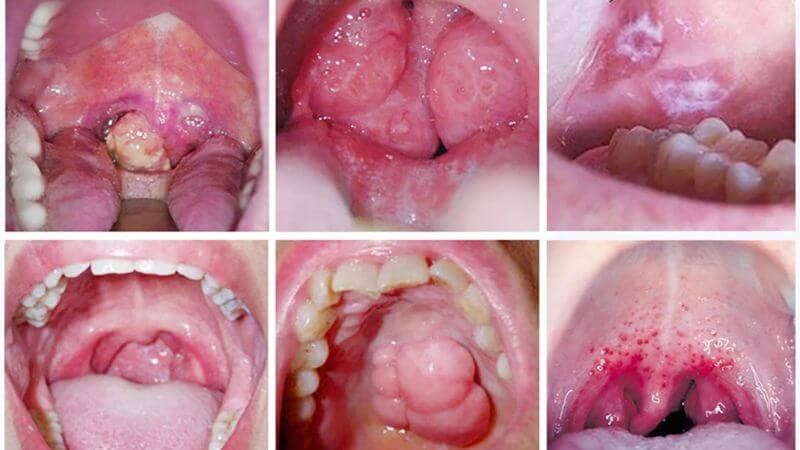 Ung thư miệng: Nguyên nhân, dấu hiệu và cách phòng ngừa