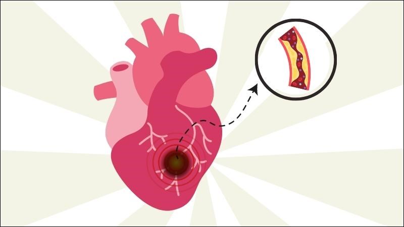 Nhồi máu cơ tim cấp là hậu quả của sự tắc nghẽn động mạch vành đột ngột