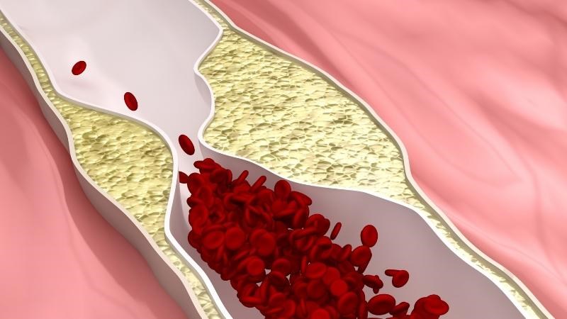 Xơ vữa động mạch là nguyên nhân hay gặp nhất của nhồi máu cơ tim cấp