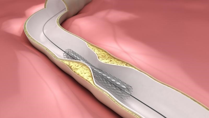 Điều trị tái tưới máu cơ tim bằng nong và đặt stent mạch vành