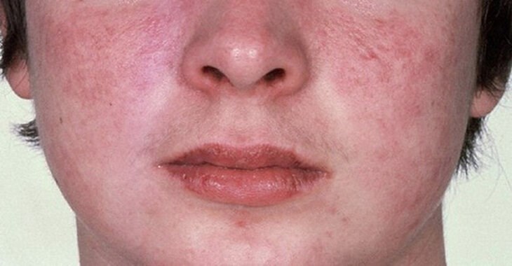 Những người có tình trạng da nhạy cảm, mụn viêm nặng cần cân nhắc và tham khảo ý kiến của bác sĩ trước khi sử dụng máy hút mụn