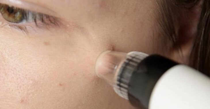 Bạn nên tách đầu máy hút mụn nhẹ nhàng sau khi sử dụng, hạn chế tác động lực mạnh