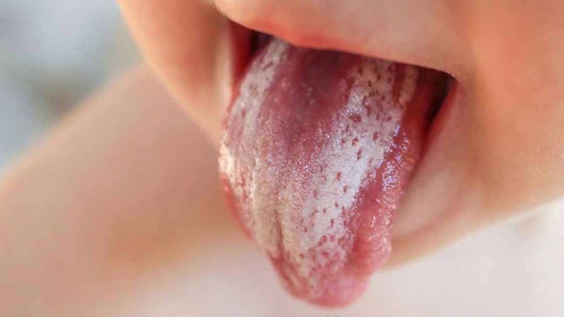 Bệnh nấm miệng thường xuất hiện những tổn thương màu trắng kem, nổi lên trên bề mặt lưỡi, má trong Bệnh nấm miệng thường xuất hiện những tổn thương màu trắng kem, nổi lên trên bề mặt lưỡi, má trong