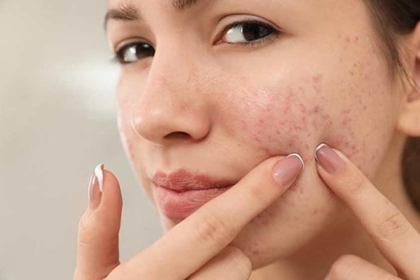 Không bôi rượu nghệ lên vùng da mụn