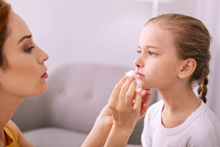 Không nên nằm hoặc ngả đầu ra sau khi chảy máu cam Không nên nằm hoặc ngả đầu ra sau khi chảy máu cam