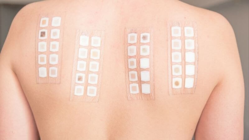 Dùng test áp da để xác định căn nguyên gây dị ứng