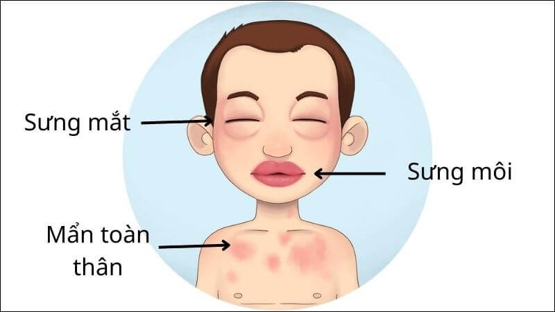 Khi có các dấu hiệu của sốc phản vệ phải đến ngay cơ sở y tế gần nhất