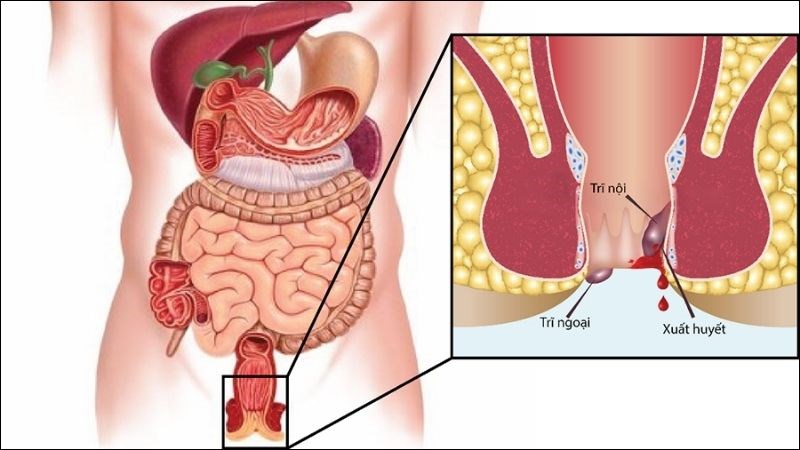 Bệnh trĩ có thể gây ra tình trạng chảy máu, đau rát ở vùng hậu môn 